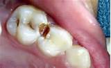 Photos of Silver Treatment For Cavities