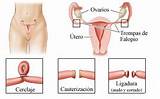 Images of How Do Doctors Treat Endometriosis