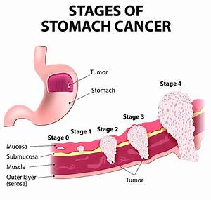 Stomach Cancer Treatment Bangalore Surgery For Stomach Tumor
