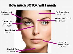 Image Result For Botox Injection Sites Chart Berricle Sterling Silver