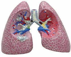 Diseased Lung Anatomical Model Anatomy Models And Anatomical Charts