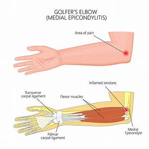 Golfer S Elbow Causes Treatment Form Hand Wrist Elbow Institute