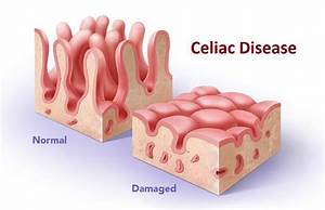 What 39 S Your Tummy Type Celiac Disease And Your Digestive Health
