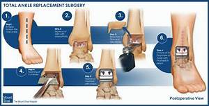 Total Ankle Replacement Surgery Mountsinai Org Everything