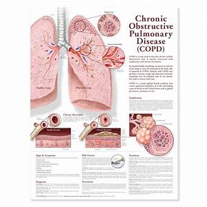 Chronic Obstructive Pulmonary Disease Copd Chart Poster Laminated