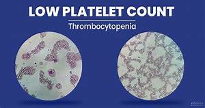 Low Platelet Count Symptoms Diagnosis Treatment And More