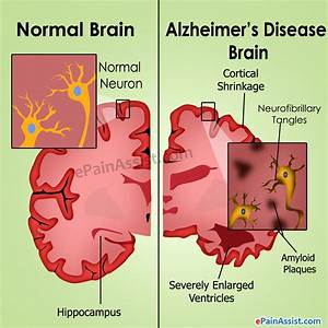 Alzheimer S Disease Causes Stages Treatment Prognosis