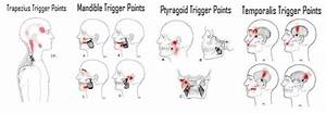  Trigger Points Chart