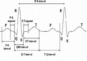 Ekg Pqrst Chart