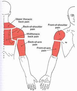 Trigger Point Section Diagram For The Upper Back Shoulder And Arm