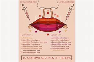 Lips Injections Image Infographic Pink Anatomical Zones Facial Fillers