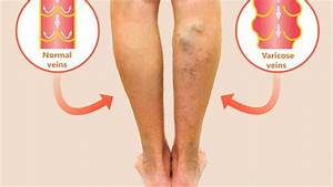Varicose Veins Treatment And Surgical Procedure Options