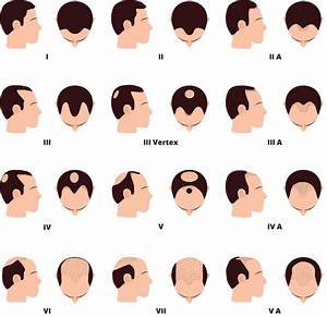  Pattern Baldness Surgical And Natural Treatments