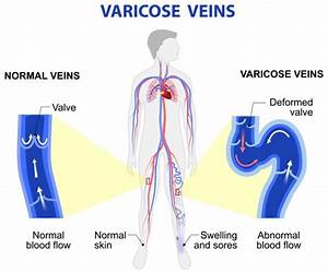 What To Expect At A Varicose Vein Screening Best Diagram Collection