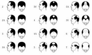 Hamilton Norwood Scale Understand The Extent Of Your Baldness