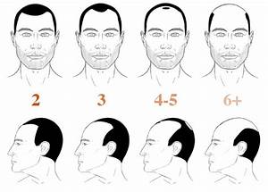 Norwood Hamilton Scale For Hair Loss Measuring Pattern Baldness