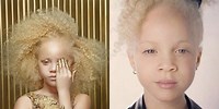 Blonde Hair Blue Eyed Albino Black Person
