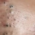 Blackheads