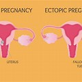 Extrauterine Ectopic Pregnancy