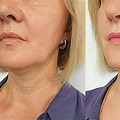 Facelift Before After