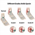 Grade 3 Ankle Sprain