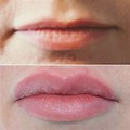 Injections Lips Result