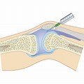 Synovial Fluid