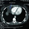 Cardiac MRI