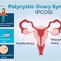 Polycystic Ovary Syndr… 