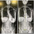 Scoliosis Spinal Fusion