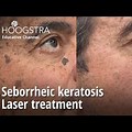 Laser Treatment