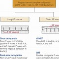 vs Atrial Fibrillation