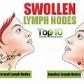 Swollen Lymph Nodes