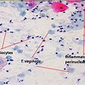 Trichomonas Vaginalis