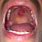 Lupus Mouth Sores