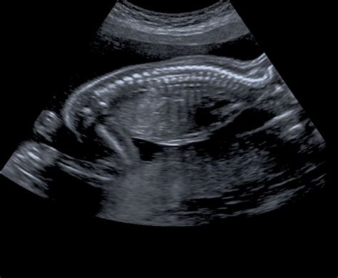 25 weeks pregnant ultrasound