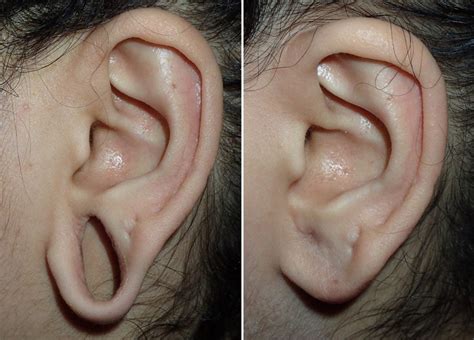 Surgical Procedures to Fix Uneven Pierced Ears