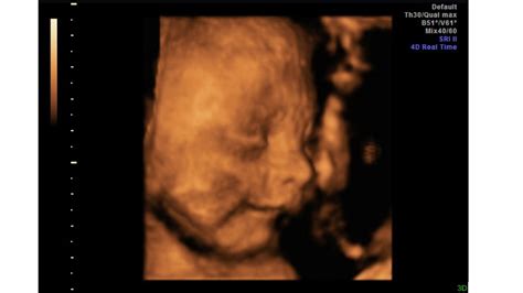 Potential Health Concerns with 25 Weeks Pregnant Ultrasound