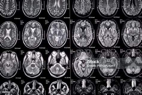 MRI Cortex Otak Manusia