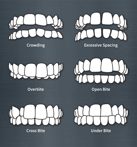 Different Types of Front Teeth Misalignment