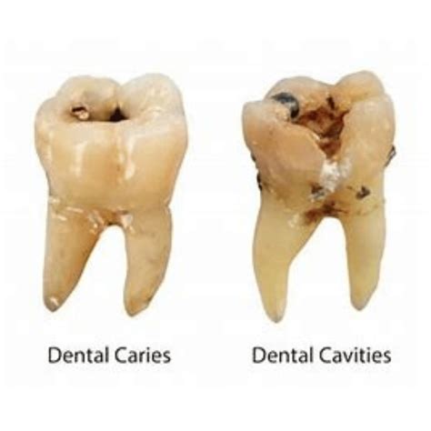 cavities