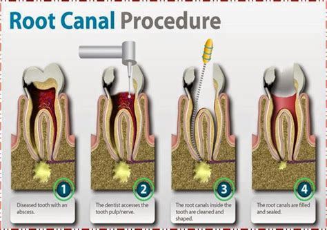Crown Without Root Canal