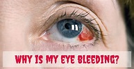 Is My Eye Bleeding? - Eye Doctor, Optometrist | Butler, Grove City, PA
