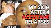 Skin Before & After Accutane (with pictures) | Post Accutane | Acne ...