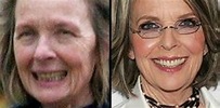 Diane Keaton Nose Job, Skin Plastic Surgery Before And After Photos