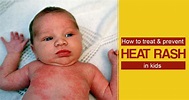 Home Remedies for Heat Rashes in Kids | Prevention and Treatment