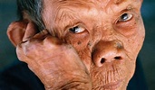 Leprosy (Hansen’s Disease): Causes, Symptoms and Treatments | Healthtian