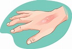 How to treat Burn - Diagnosis and treatment | Shop Wound Care