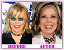 Diane Keaton Plastic Surgery Before and After Nose Job and Eyelid ...