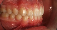 MORDIDA PERFECTA - Dentista Medica Sur